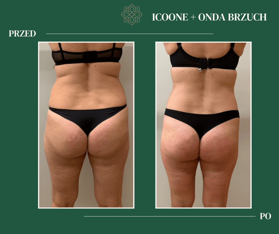 ICOONE-ONDA-BRZUCH-przed-po