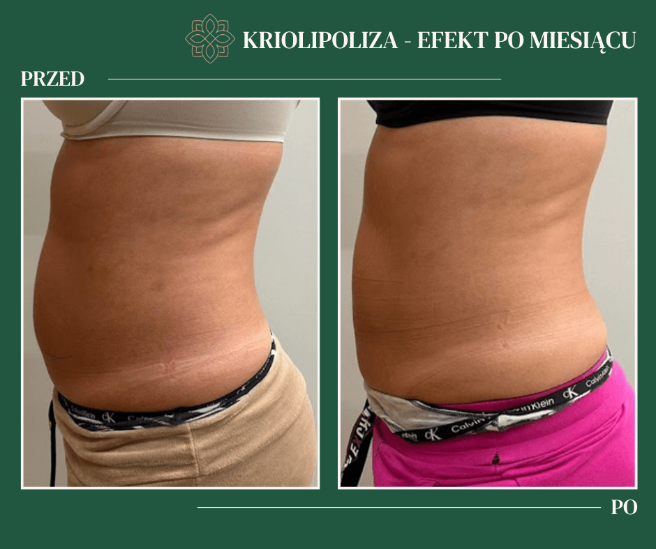 KRIOLIPOLIZA przed i po 1mc
