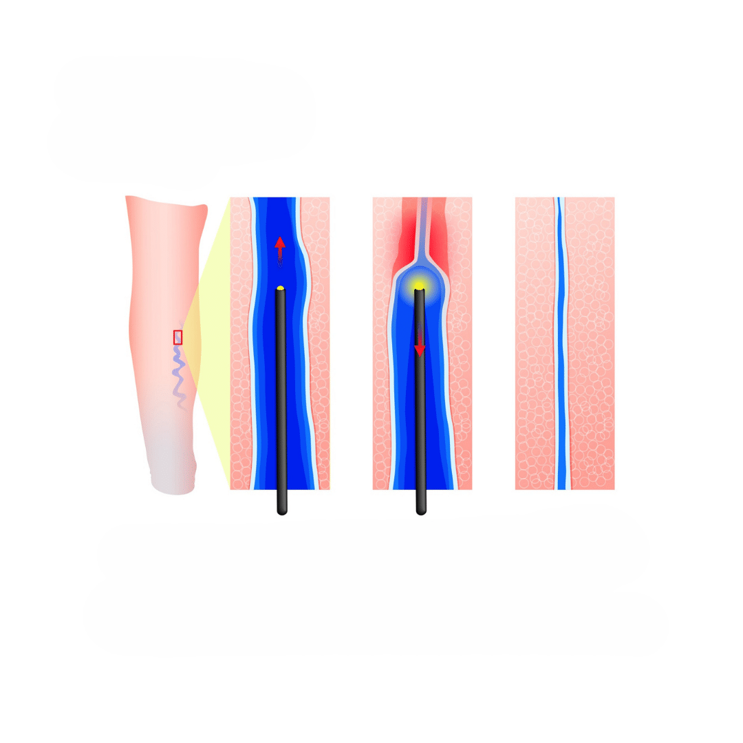 lvt leczenie żylakó gdańsk